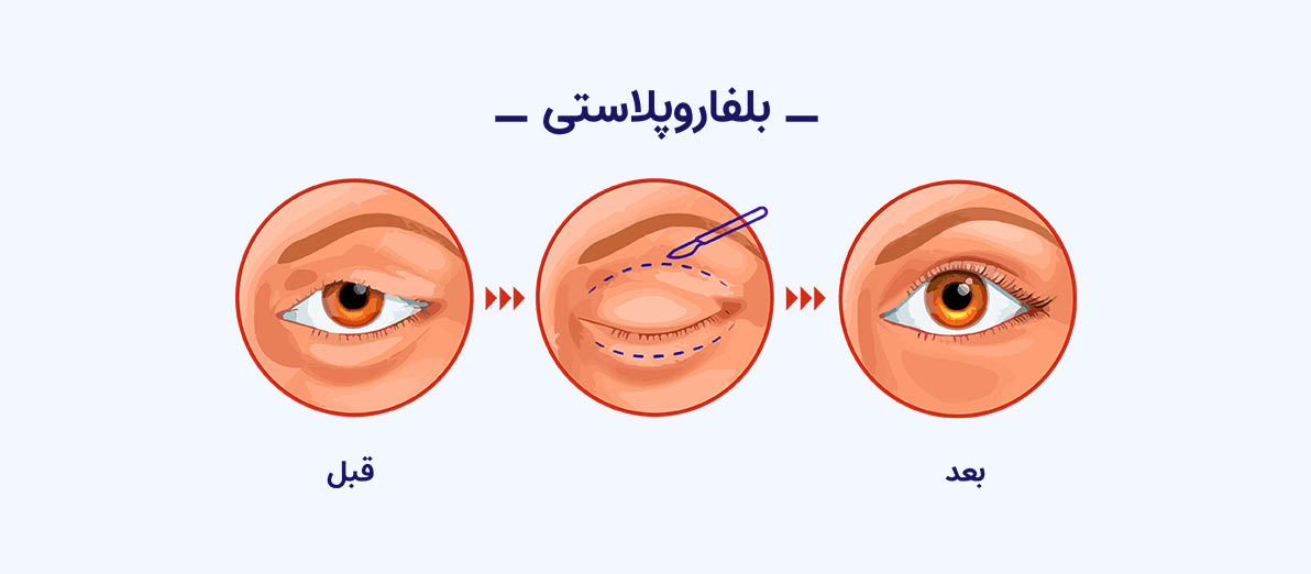 بلفاروپلاستی