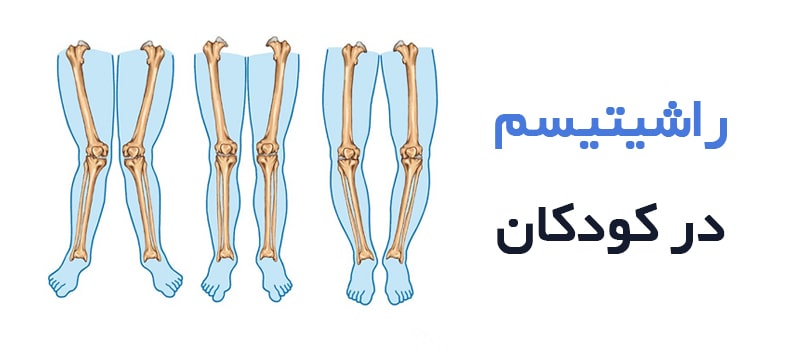 راشیتیسم در کودکان