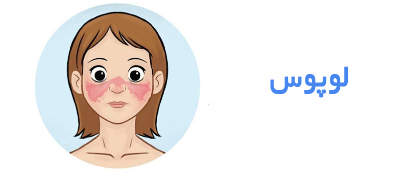لوپوس چیست؟