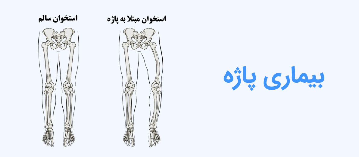 بیماری پاژه