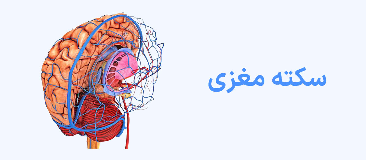 سکته مغزی