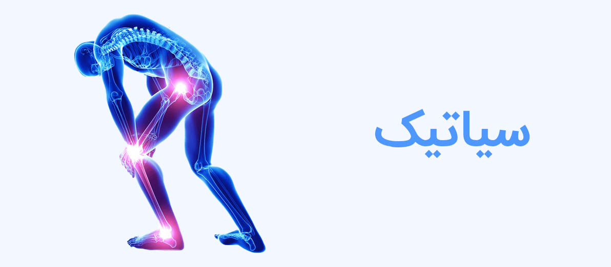 سیاتیک