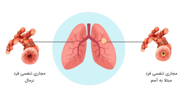 آسم یا تنگی نفس چقدر خطرناک است؟