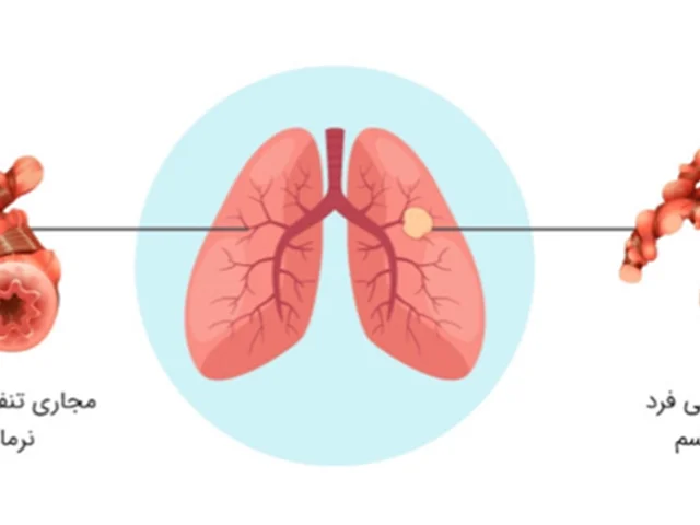 آسم یا تنگی نفس چقدر خطرناک است؟