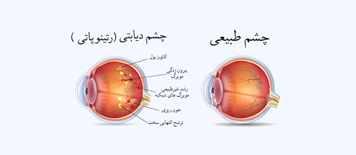 رتینوپاتی دیابتی