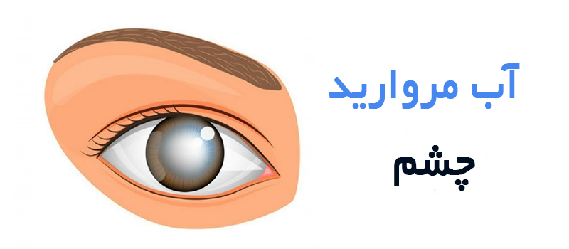 منظور از آب مروارید چشم چیست؟
