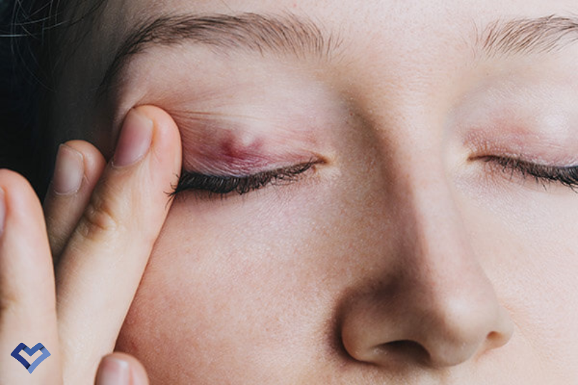 بلفاریت، علائم و درمان آن