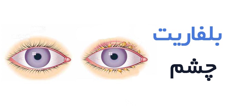 بلفاریت چشم
