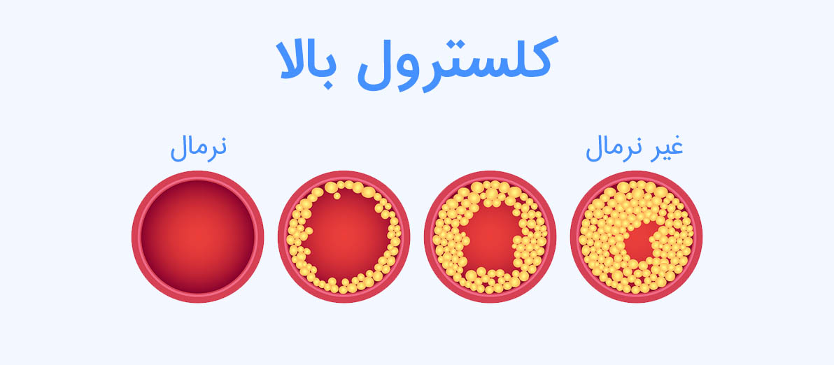 کلسترول بالا