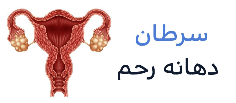 خطر ابتلا به سرطان دهانه رحم