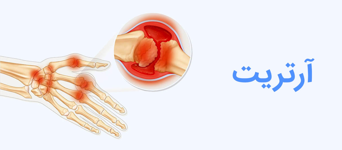 آرتریت