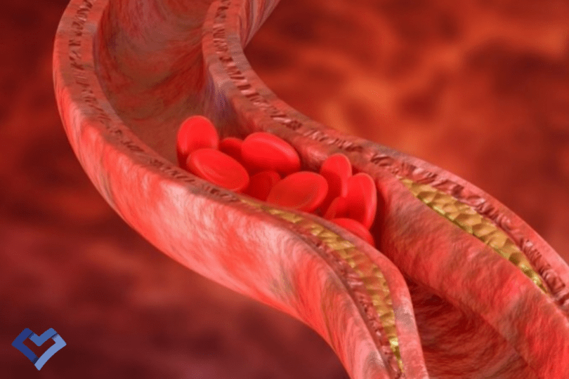 واسکولیت (التهاب رگ) چیست؟