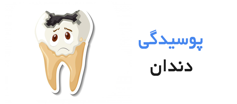 پوسیدگی دندان و پیشگیری از آن